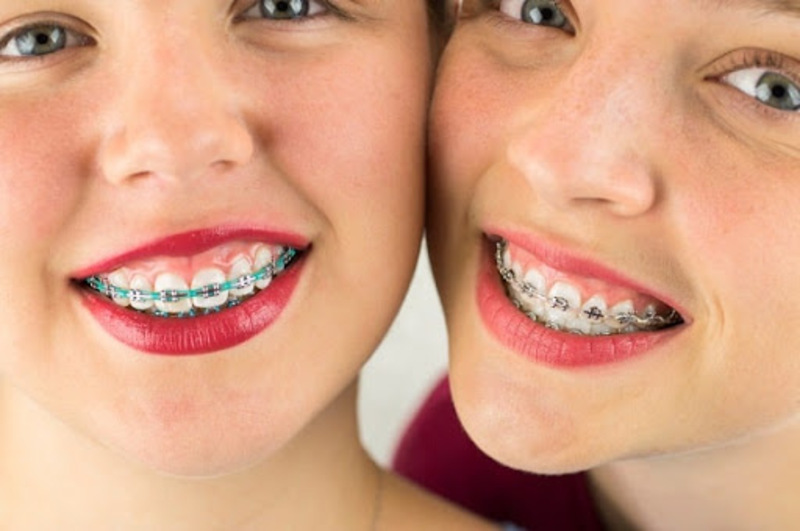 Phương pháp niềng răng của trẻ em khác với việc niềng răng ở người lớn 