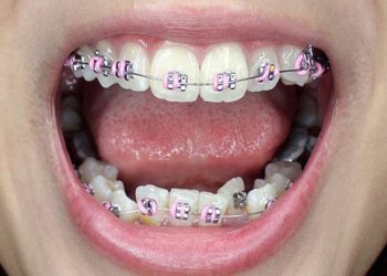 Quá trình niềng răng khểnh gồm nhiều bước phước tạp