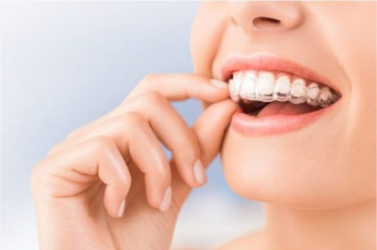Tìm hiểu các loại niềng răng trong suốt