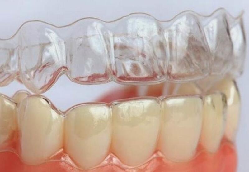 Có rất nhiều loại niềng răng trong suốt để bạn có thể lựa chọn 