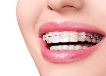 Top 5 dây cung niềng răng phổ biến và những lưu ý khi sử dụng