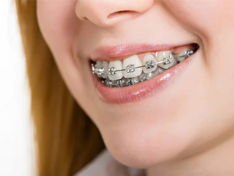 Niềng răng móm là phương pháp chỉnh nha được nhiều người lựa chọn hiện nay