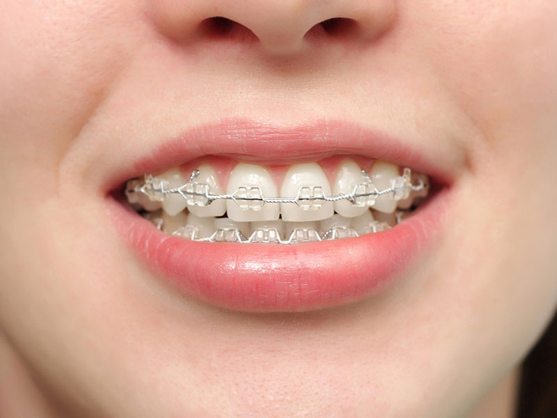 Niềng răng móm Chỉnh nha bằng mắc cài sứ giúp cải thiện nhiều khiếm khuyết về răng