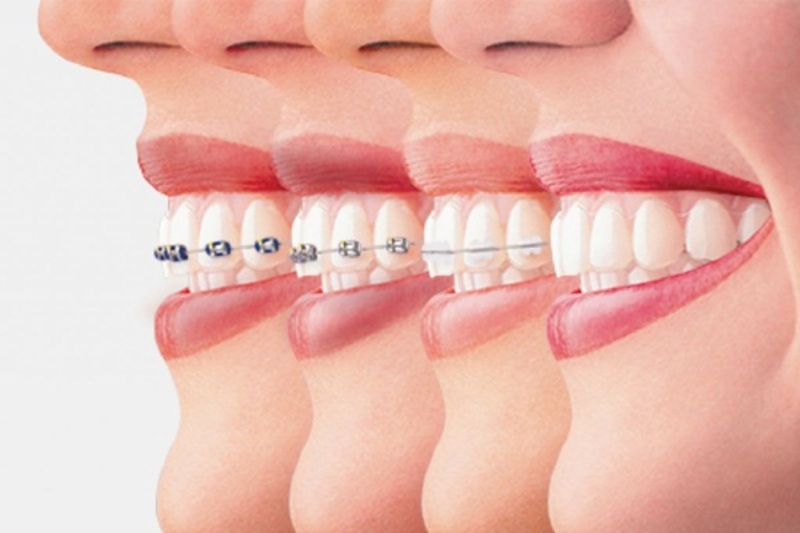 Việc niềng răng sớm sẽ mang lại cho bạn nhiều lợi ích bất ngờ
