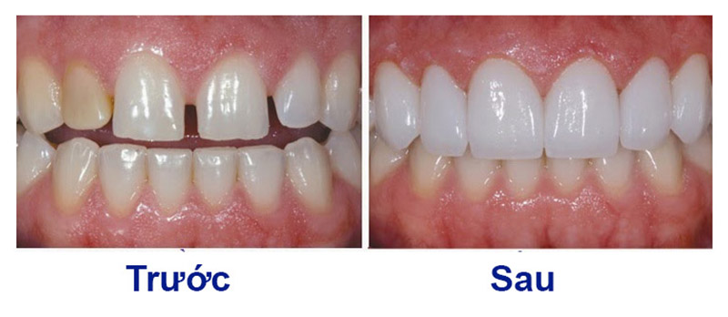 Niềng răng thưa trước và sau