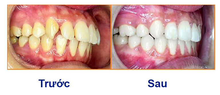 Hình ảnh trước và sau khi niềng răng hô