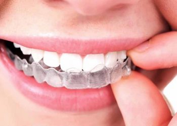 Niềng răng vô hình là gì? Chi phí và hiệu quả mang lại