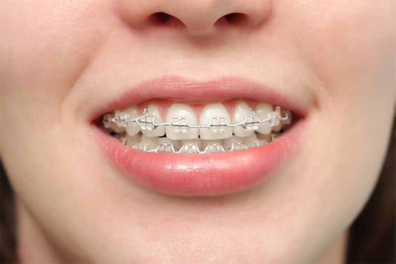 Tay nghề của bác sĩ nha khoa quyết định khá lớn tới kết quả của quá trình niềng răng