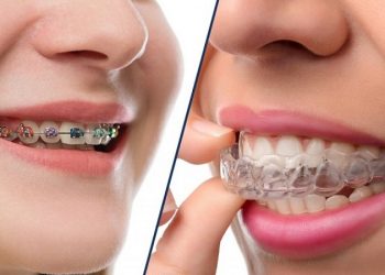 niềng răng xong vẫn xấu
