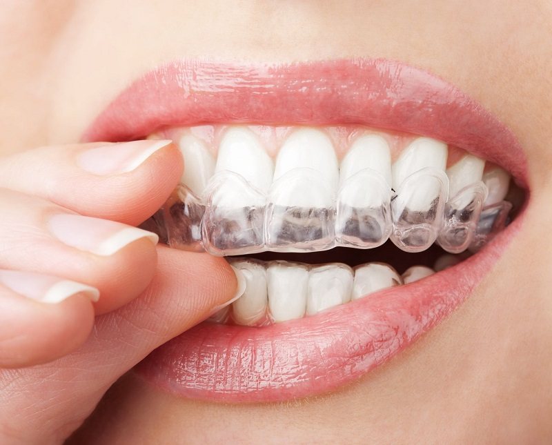 Các phương pháp niềng răng hô phổ biến nhất Các phương pháp niềng răng hô phổ biến nhất