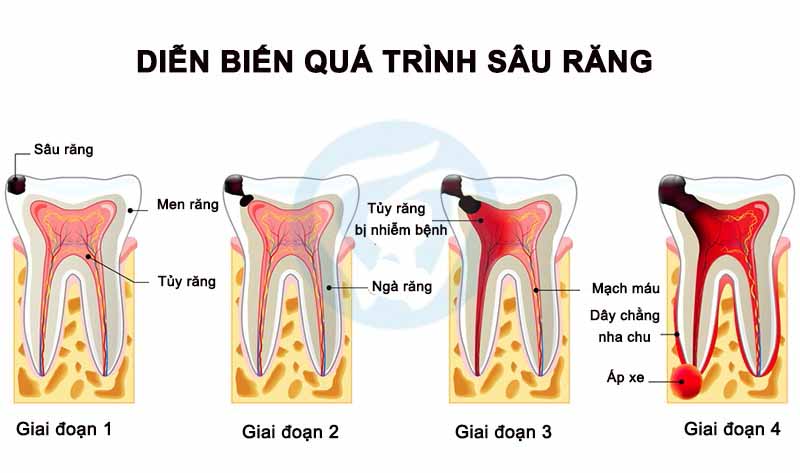 Các giai đoạn tiến triển của bệnh sâu răng
