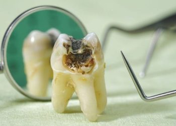 Trường hợp răng bị sâu nặng có thể phải chỉ định nhổ bỏ, tránh những biến chứng nguy hiểm hơn
