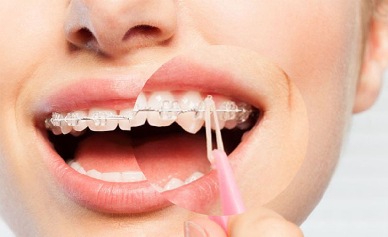 Vệ sinh răng miệng theo đúng chỉ dẫn giảm tác hại của niềng răng tại nhà.