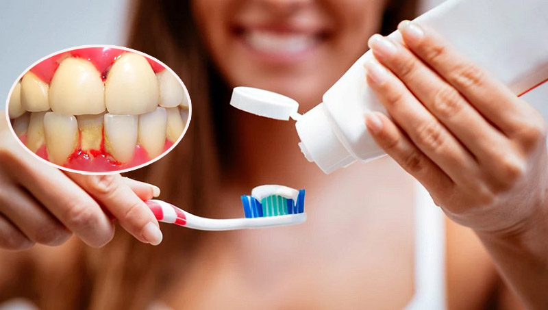 Viêm, sưng lợi nguyên nhân chủ yếu là do vệ sinh răng miệng kém