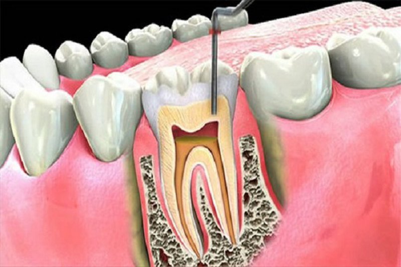Điều trị áp xe bằng phương pháp rút tủy răng