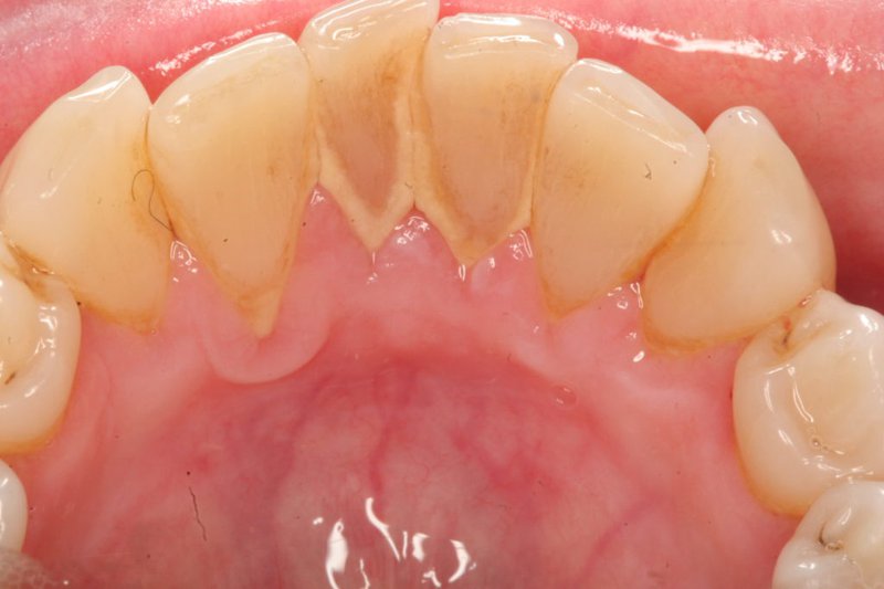 Cao răng bám lấy mặt bên trong của răng cần được lấy đi để không làm hại men răng