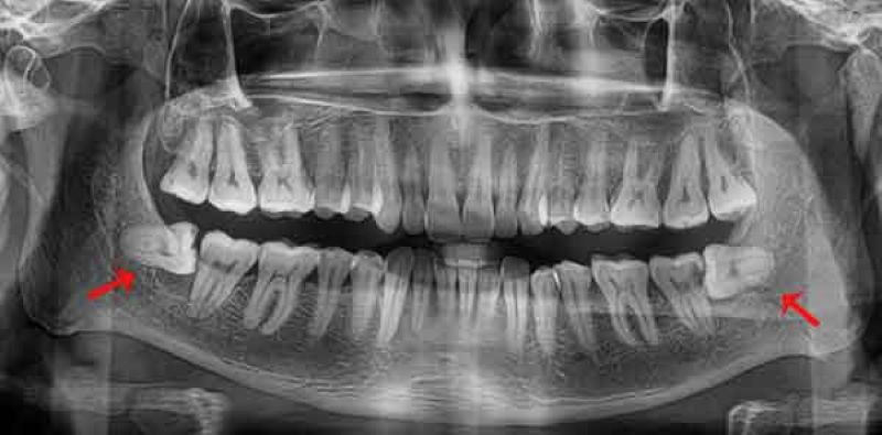 Chụp X-Quang là bước đầu tiên và quan trọng nhất của quá trình niềng răng