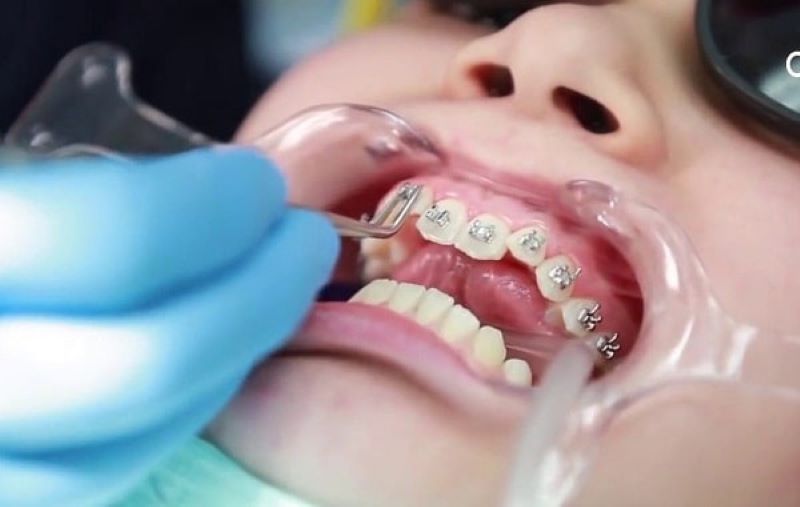 Quá trình niềng răng có thể gây đau đớn nếu quy trình thực hiện không đảm bảo