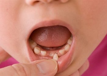 Với các trường hợp răng trẻ mọc lẫy khi đã có nhiều răng vĩnh viễn thì có thể niềng răng để cải thiện
