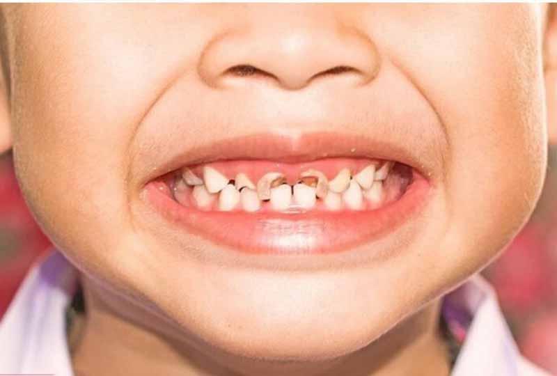 Trẻ bị sâu răng không điều trị sớm có thể gây ra nhiều biến chứng nguy hiểm