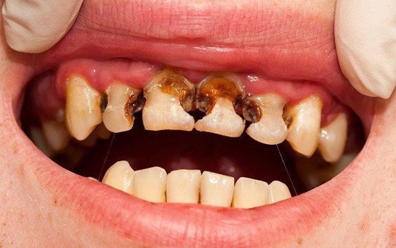 Sún răng là bệnh lý răng miệng thường gặp
