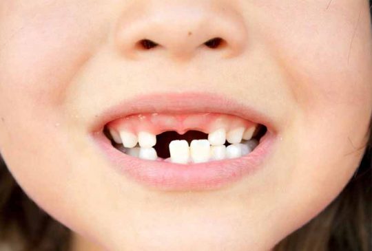 Sún răng cửa thường xảy ra phổ biến ở trẻ 1 – 3 tuổi