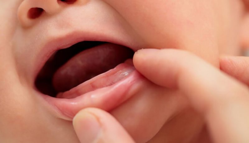 Cha mẹ thường rất sốt ruột khi thấy con mình mọc răng chậm hơn so với bạn bè cùng trang lứa.
