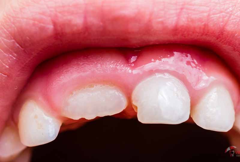 Trẻ nhỏ trong giai đoạn mọc răng cũng có nguy cơ mắc bệnh viêm lợi