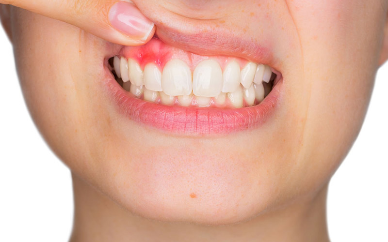 Một trong số những biến chứng nguy hiểm của đau răng là bệnh viêm chân răng