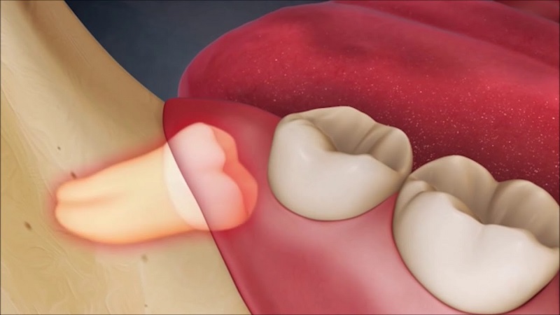 Khu vực mọc răng khôn đau nhức sẽ dẫn tới hiện tượng viêm nhiễm