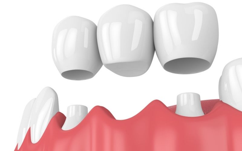 Giá trồng răng giả Bắc cầu sứ là phương pháp làm răng có chi phí thấp nhưng vẫn đảm bảo chức năng ăn nhai