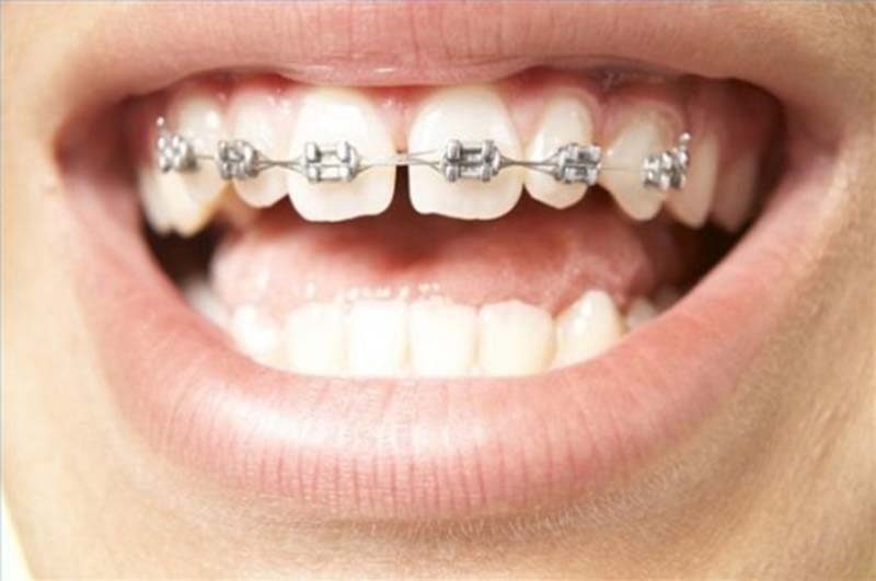 Niềng răng có hôn được không đang là câu hỏi của rất nhiều người
