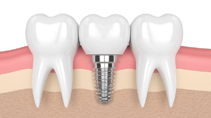 Trồng răng implant trả góp đang là dịch vụ được nhiều người lựa chọn hiện nay