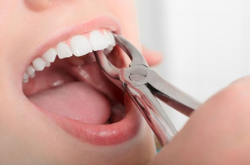 Bác sĩ giải đáp nhanh nhổ răng không trồng lại có sao không?
