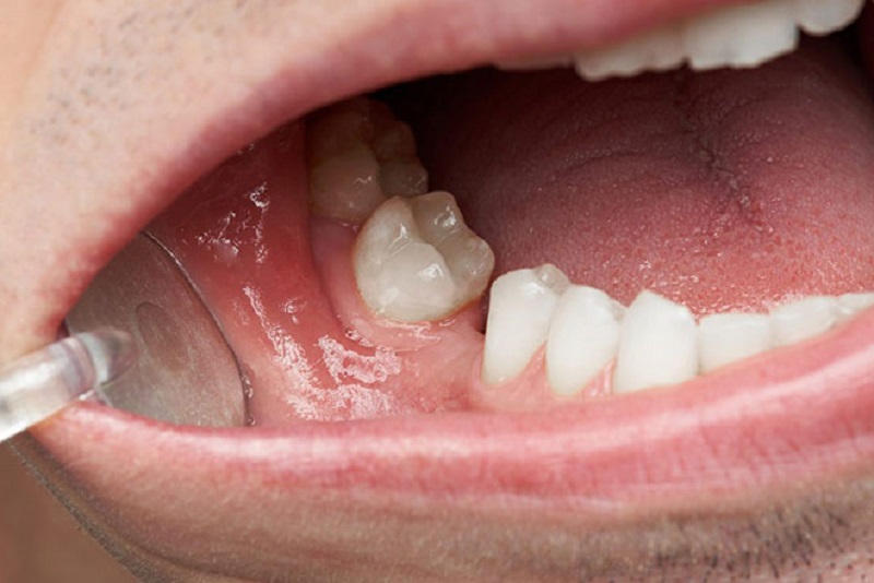 Nhổ răng nhưng không trồng lại có thể gây ra bệnh lý răng miệng