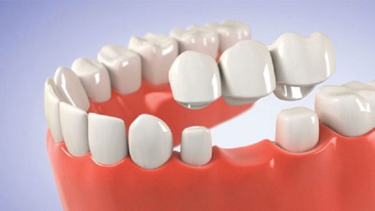 Trồng răng bắc cầu là giải pháp giúp khôi phục tính thẩm mỹ và khả năng ăn nhai tốt