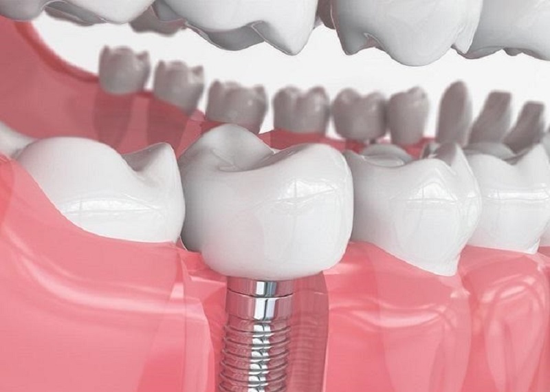 Phục hình cấu trúc răng bằng cấy ghép Implant