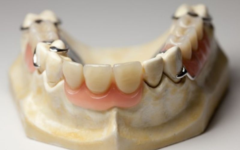 Trồng răng cửa bằng răng giả tháo lắp được coi là biện pháp đơn giản và dễ thực hiện