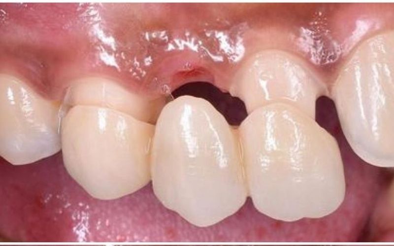 Phương pháp trồng răng cửa bằng cầu răng sứ là phương pháp phổ biến và được nhiều người an tâm lựa chọn
