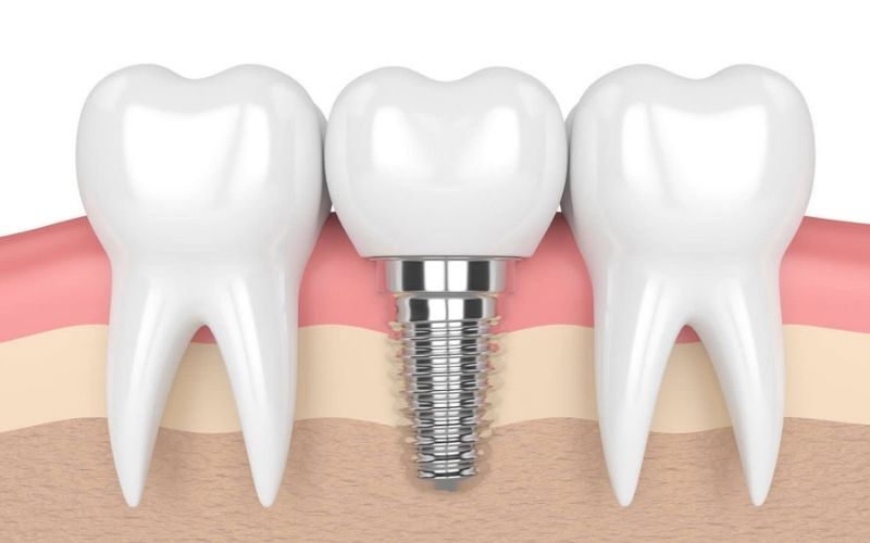 Trồng răng cửa bằng phương pháp implant là phương pháp hiện đại và có thời gian sử dụng trọn đời