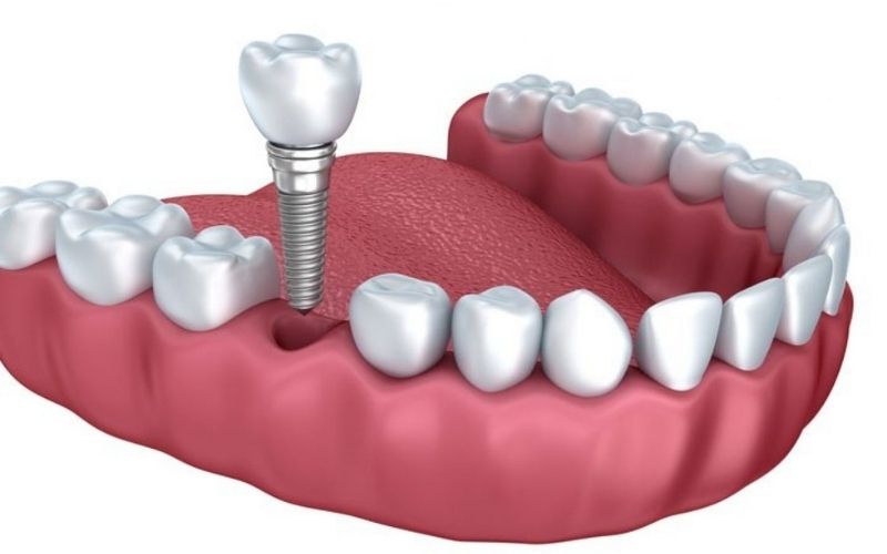 Trồng răng giả có ảnh hưởng gì không phụ thuộc vào tay nghề bác sĩ và nha khoa thực hiện