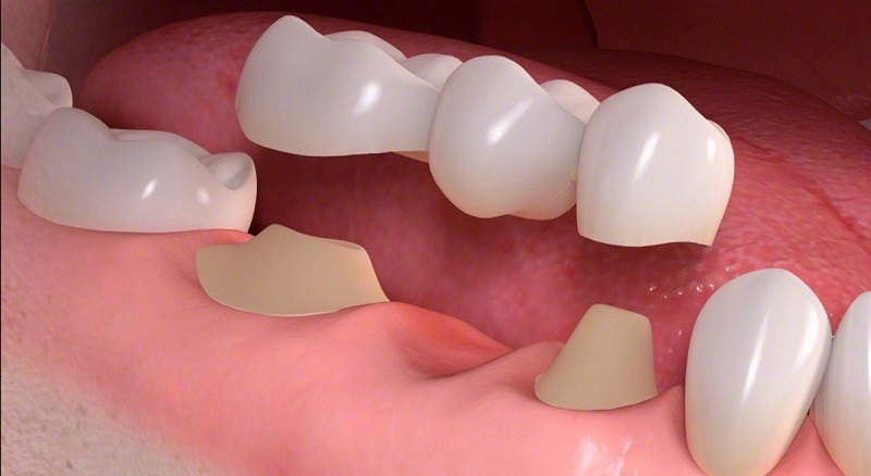 Trồng răng giả cố định là giải pháp mang đến tính thẩm mỹ và khôi phục khả năng ăn nhai cho người mất răng