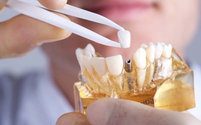 Trồng răng giả mất bao lâu là câu hỏi được nhiều người quan tâm