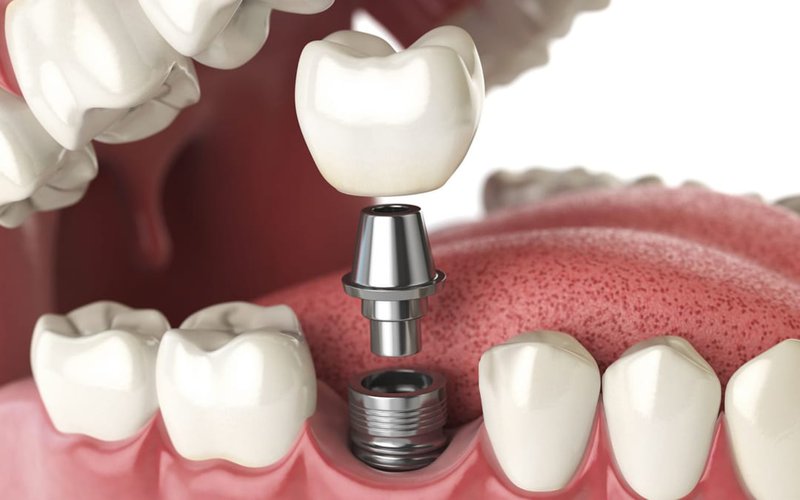Quá trình trồng răng Implant đòi hỏi từ 6 - 14 tuần để trụ tích hợp được với xương hàm
