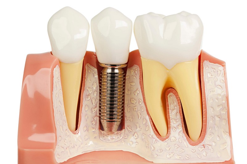 Răng khểnh được trồng bằng kỹ thuật Implant có vẻ ngoài tự nhiên y như răng thật