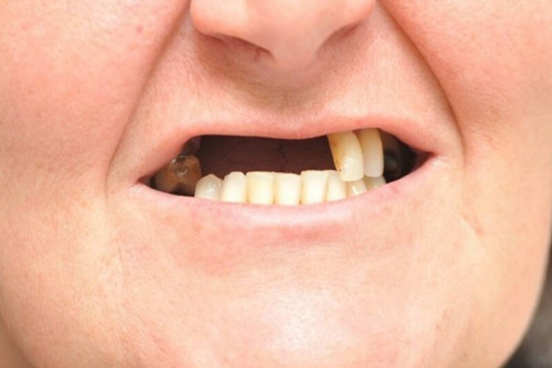 Người già là đối tượng thường phải trồng răng giả nguyên hàm