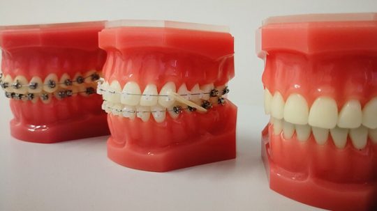 Niềng răng giữ lại răng khểnh