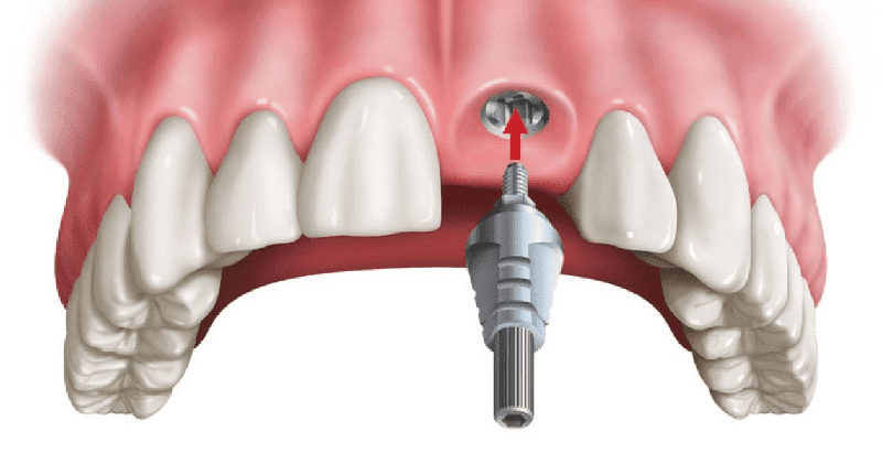 Trồng răng cửa giá bao nhiêu sẽ phụ thuộc vào nhiều yếu tố khác nhau
