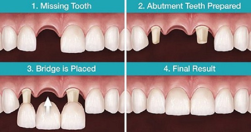 Phục hình răng cửa bằng cầu răng sứ sẽ đảm bảo tính thẩm mỹ cho bạn