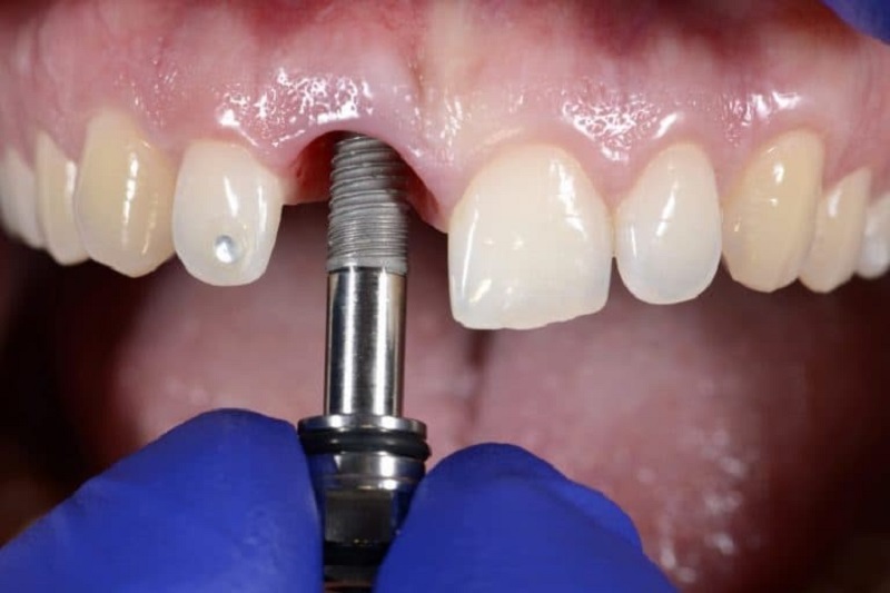 Trồng răng cửa Implant có thể ngăn ngừa tình trạng tiêu xương hàm và bền lâu theo thời gian